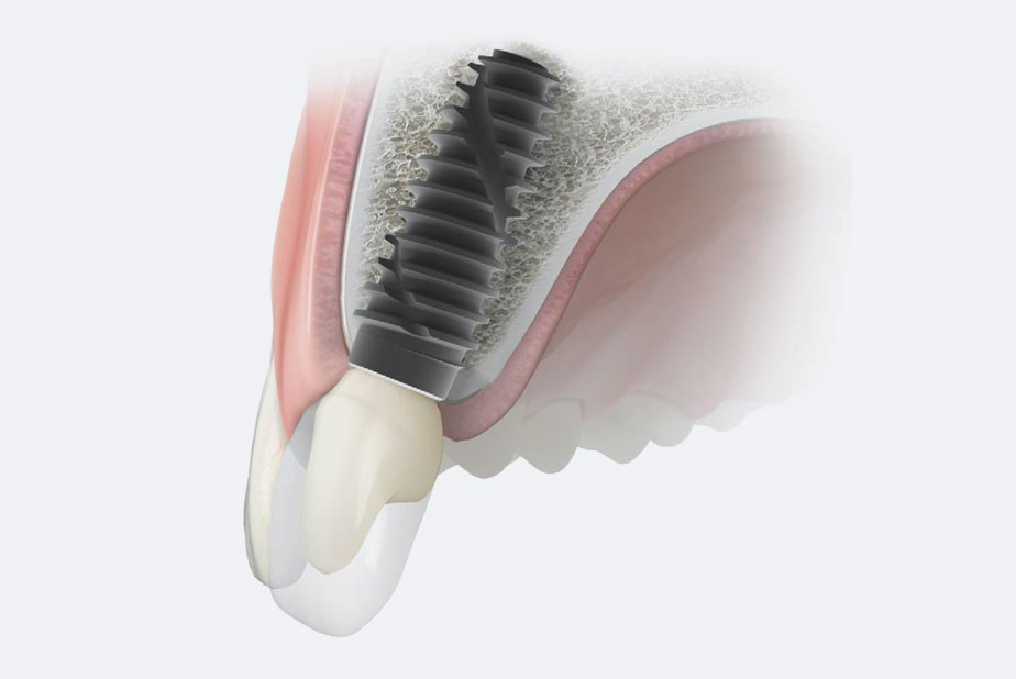 Linea implantare IS+