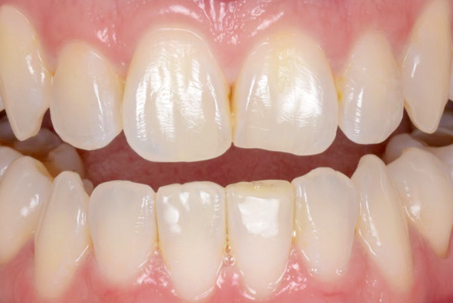 Miglioramento estetico trattamento post-ortodontico con 3M™ Filtek™ Easy Match Universal Restorative