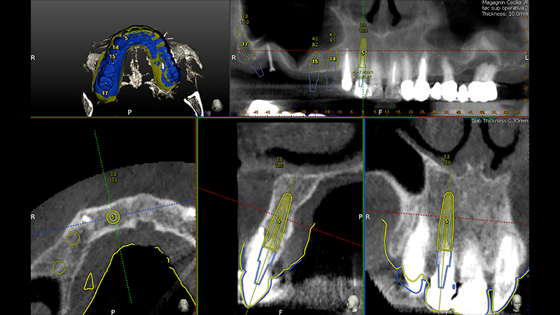 Pianificazione chirurgica della posizione implantare su Software Navident