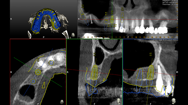Pianificazione chirurgica della posizione implantare su Software Navident