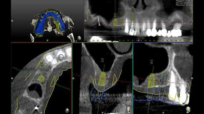 Pianificazione chirurgica della posizione implantare su Software Navident