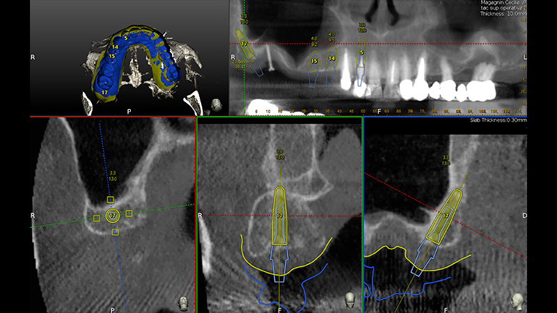 Pianificazione chirurgica della posizione implantare su Software Navident