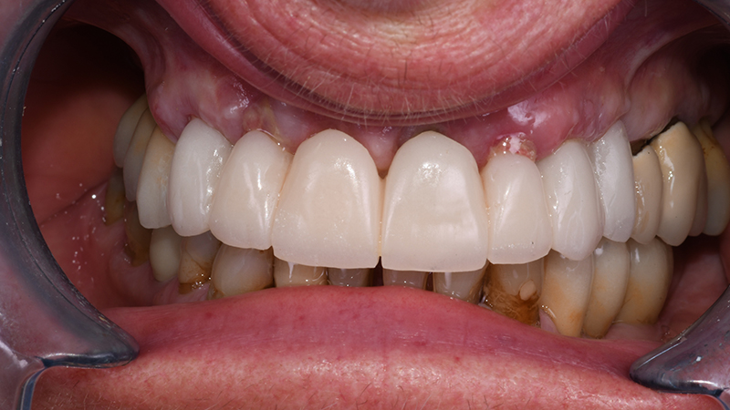 Visione frontale intra-orale dopo applicazione di protesi provvisoria a carico immediato