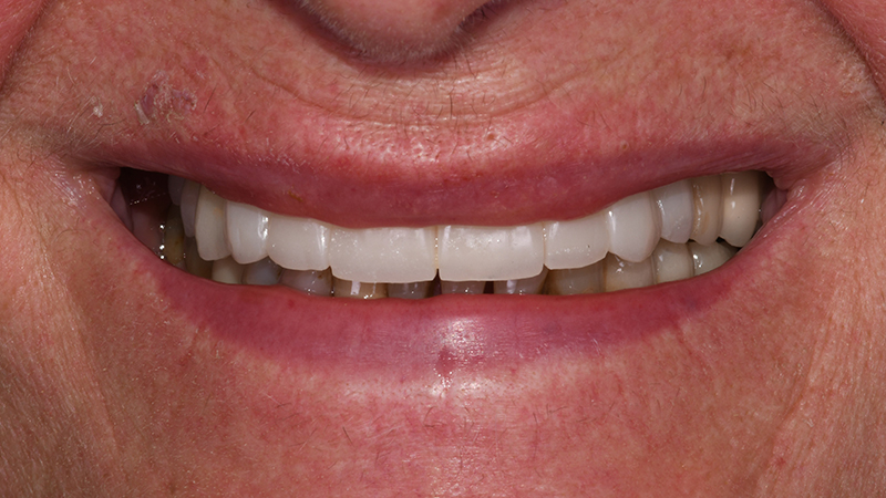 Sorriso in visione frontale extra-orale dopo applicazione di protesi provvisoria a carico immediato