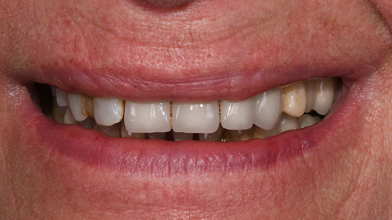 Sorriso in visione frontale extra-orale