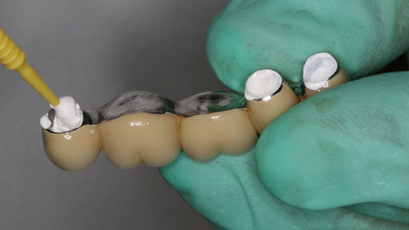 Applicazione ponte 17 - 14 in metallo ceramica su cappette conometriche passivate in bocca mediante cemento Multilink Hybrid e risultato finale