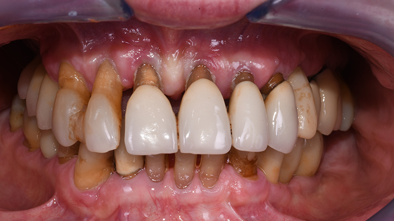 Sorriso in visione frontale intra-orale