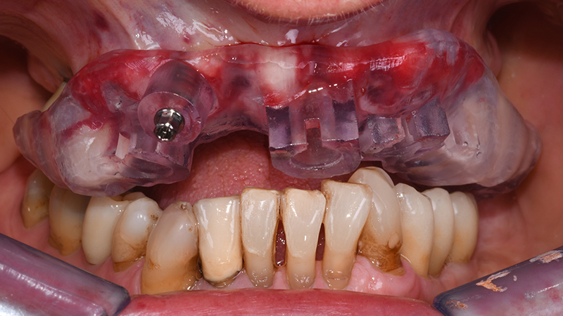 Visione frontale R2Guide in situ dopo applicazione pin di fissazione