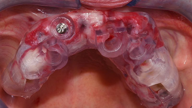 Visione occlusale R2Guide