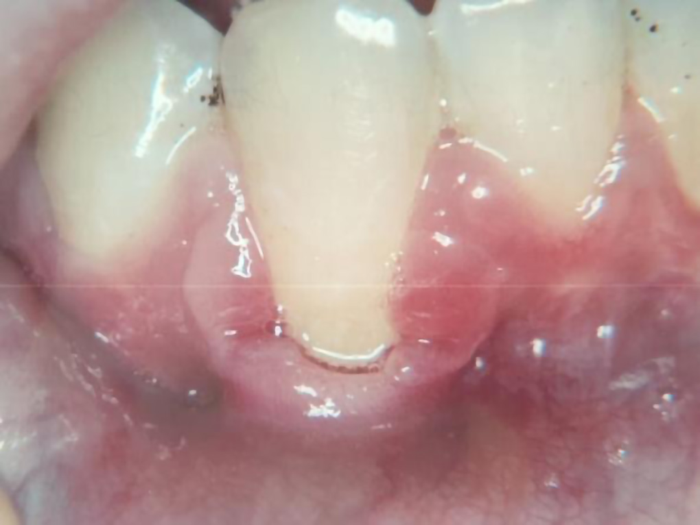Baseline (t0)