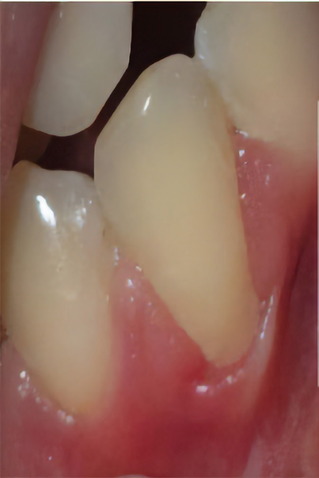 Situazione a un mese, permane recessione di 2 mm