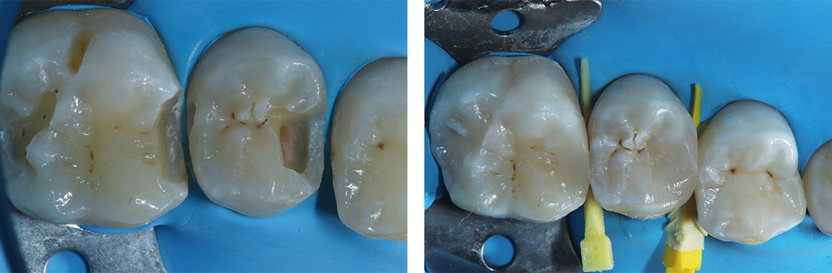 Utilizzzo simultaneo di Wadge Wands e Strata G