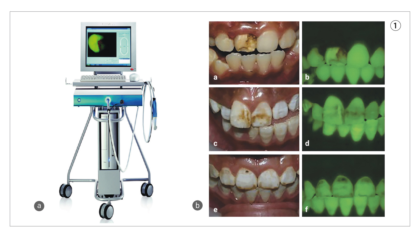 Macchinario Qray e immagine clinica del paziente con e senza fluorescenza 