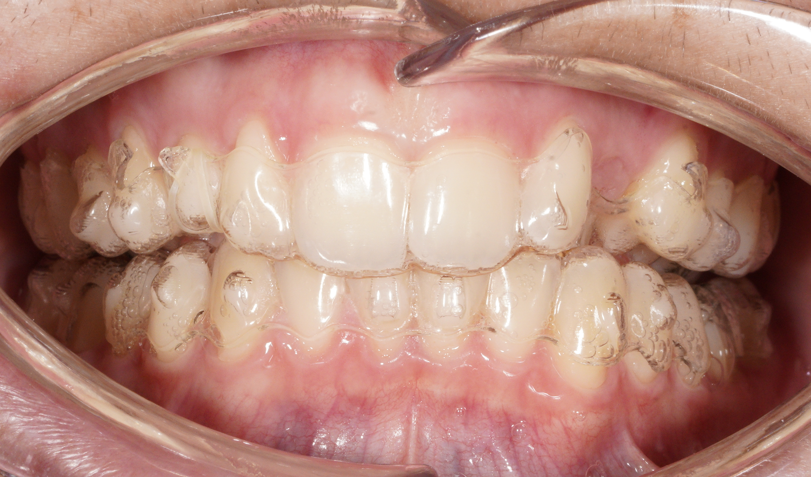 integrazione allineatori paziente