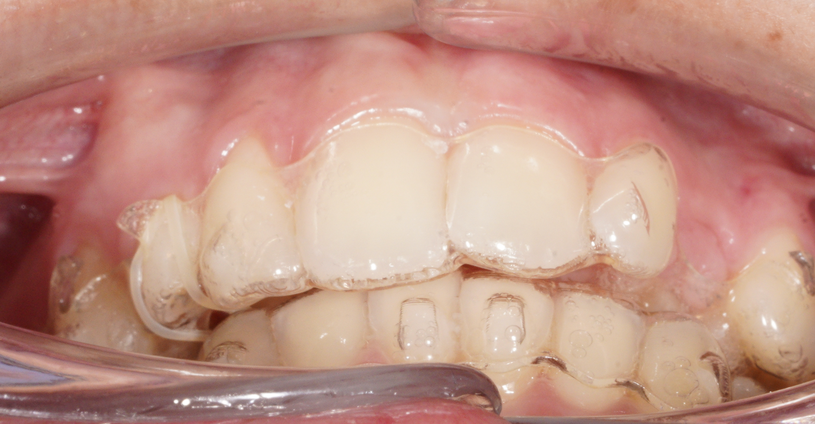 allineatori su paziente