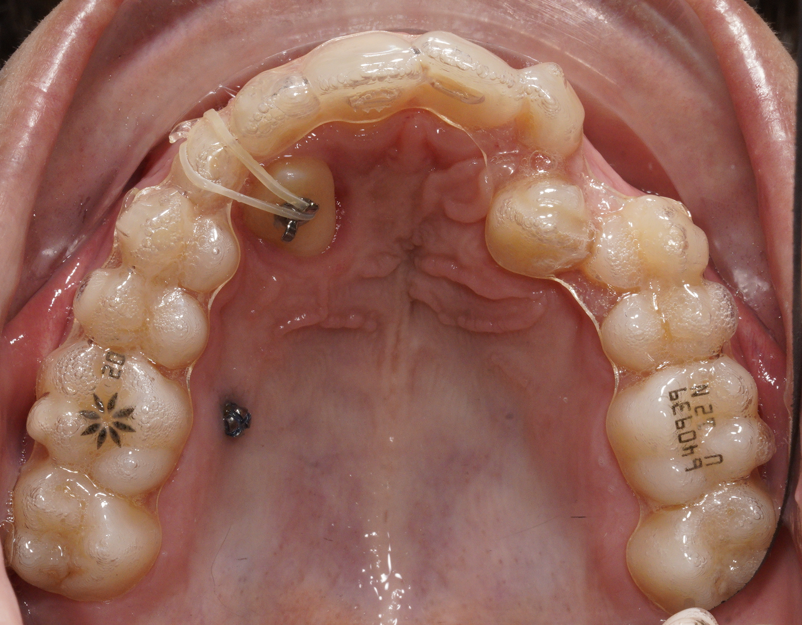 allineatori con elastico su paziente