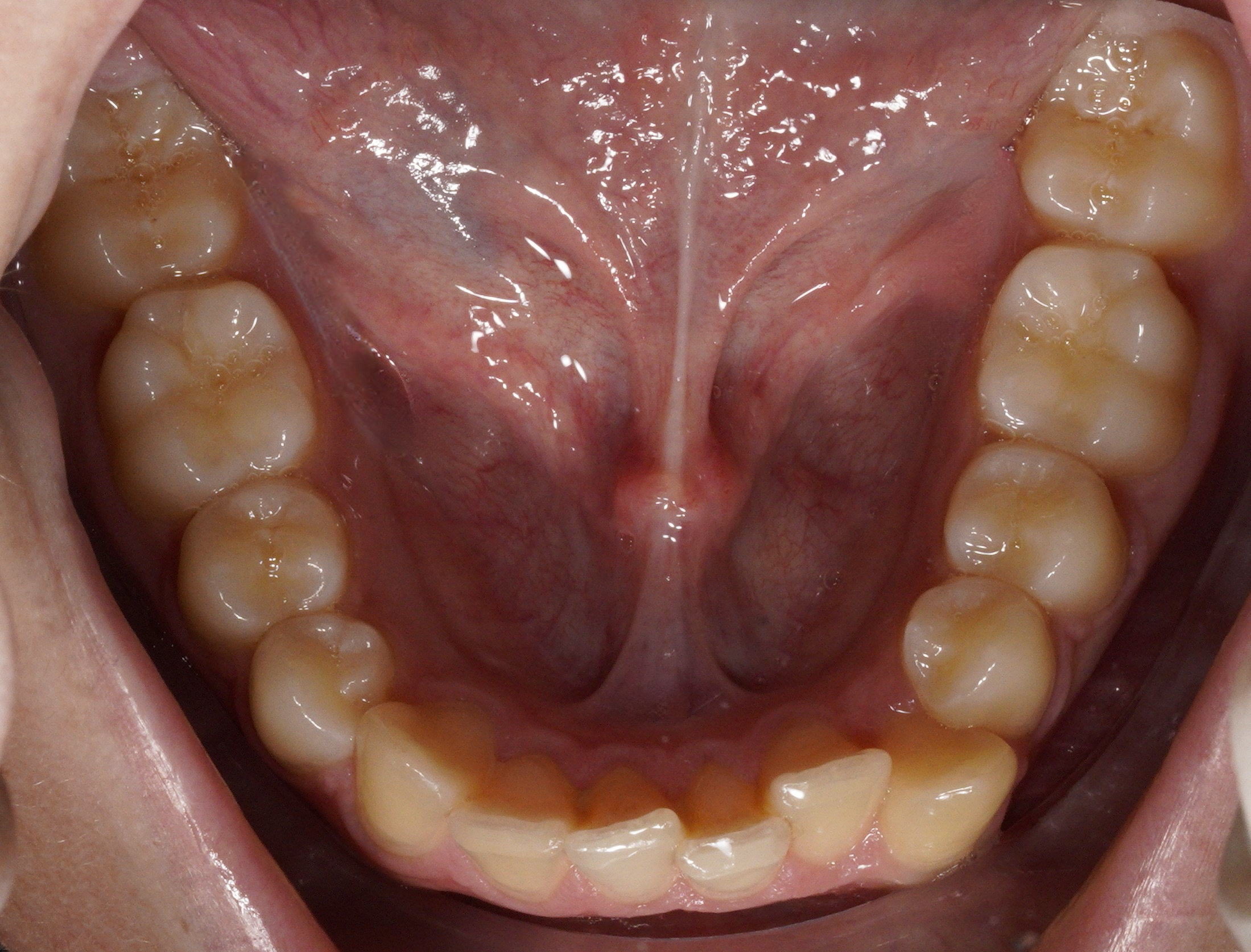 Analisi intra-orale paziente 3