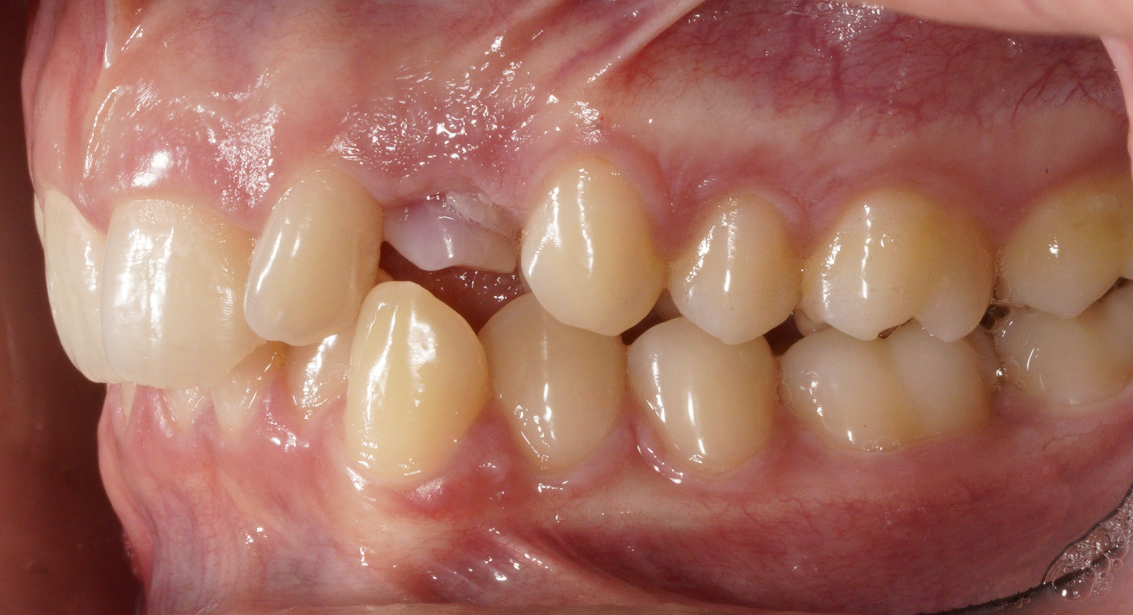 Analisi intra-orale paziente 2