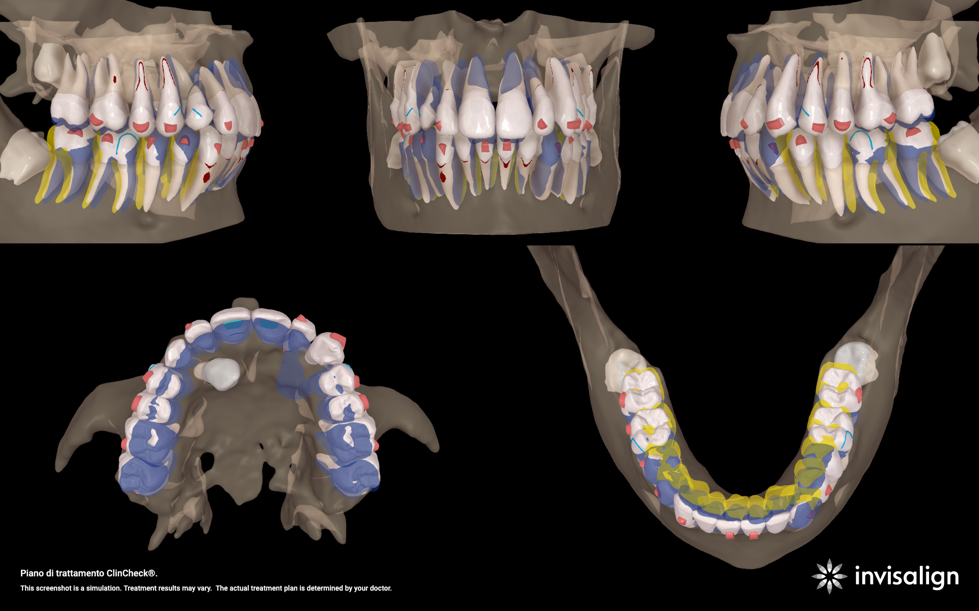 Scansione con ClinCheck Align Technology