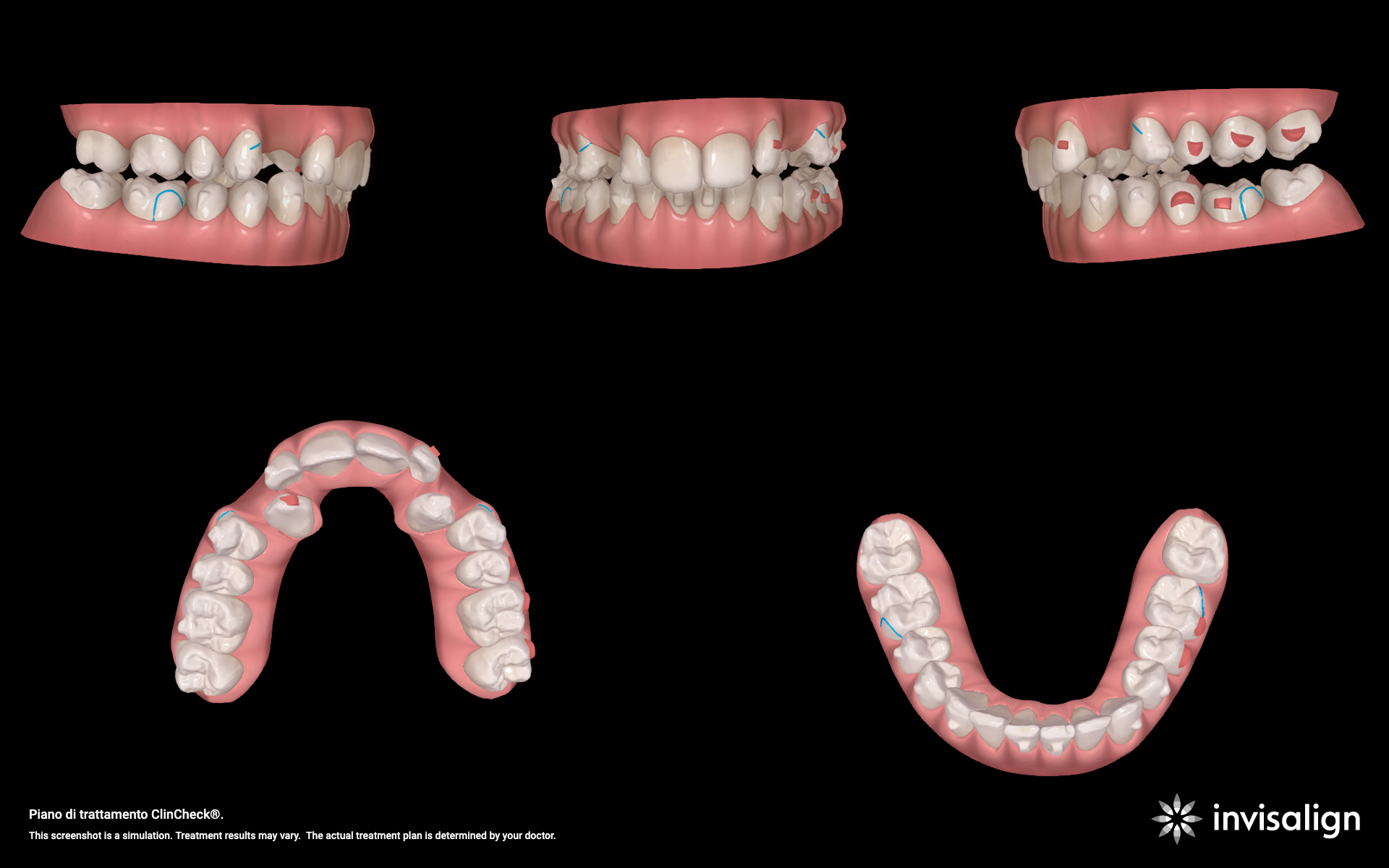Scansione e piano di trattamento ClinCheck Align Technology