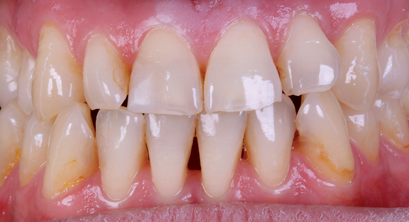 Situazione iniziale vista frontale