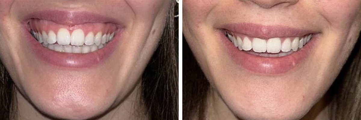 Trattamento di gummy smile con tossina botulinica