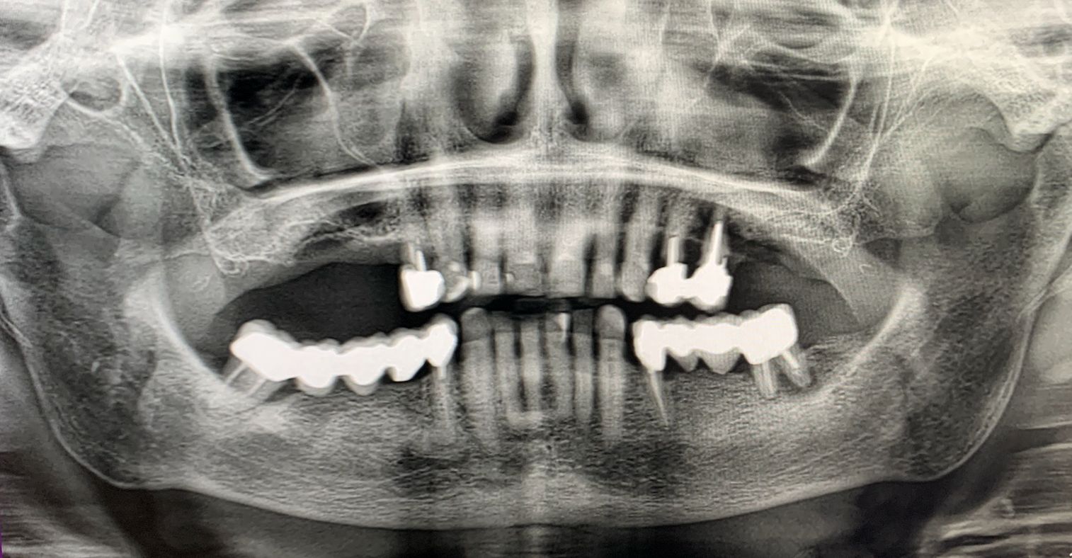 Valutazione clinica e radiografica preoperatoria