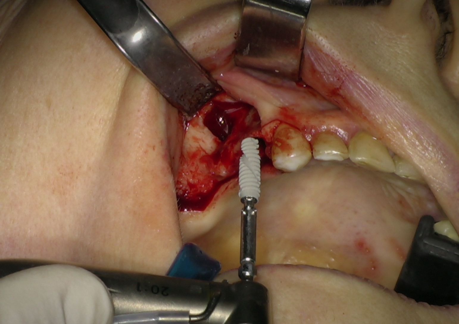 Fig. 2 - Impianti IS+