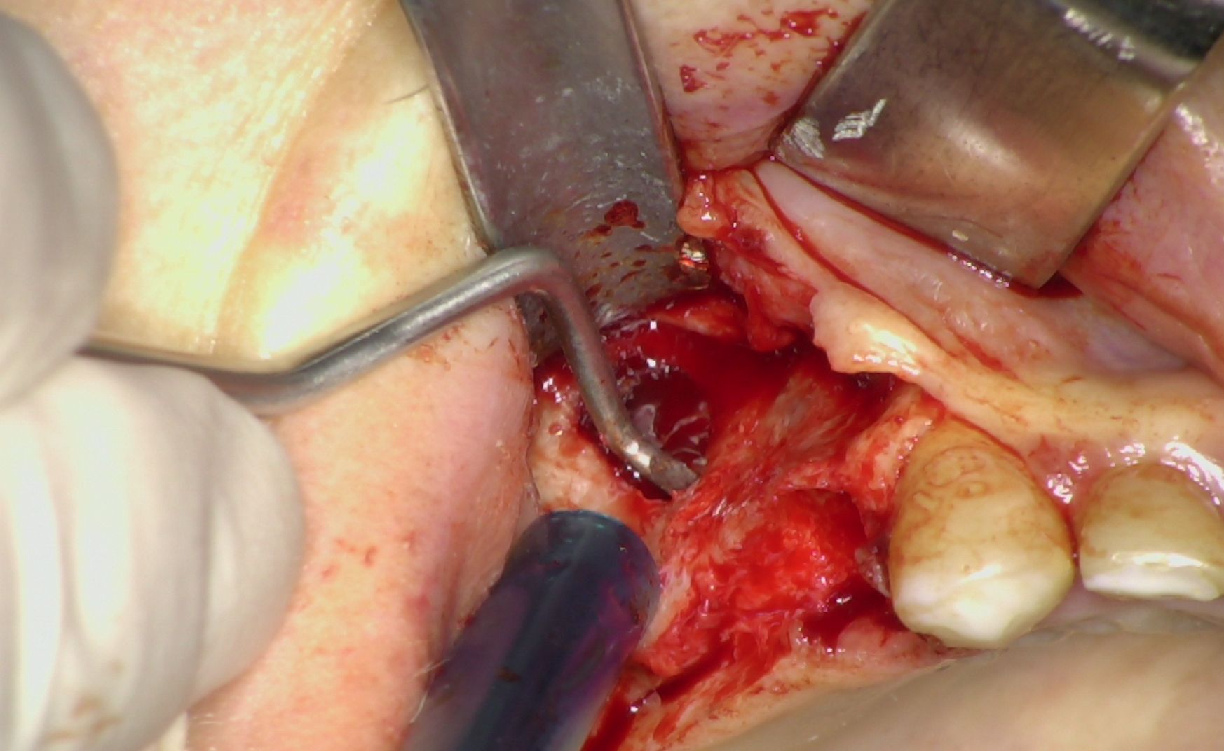 Fig. 3 - Membrana di Schneider