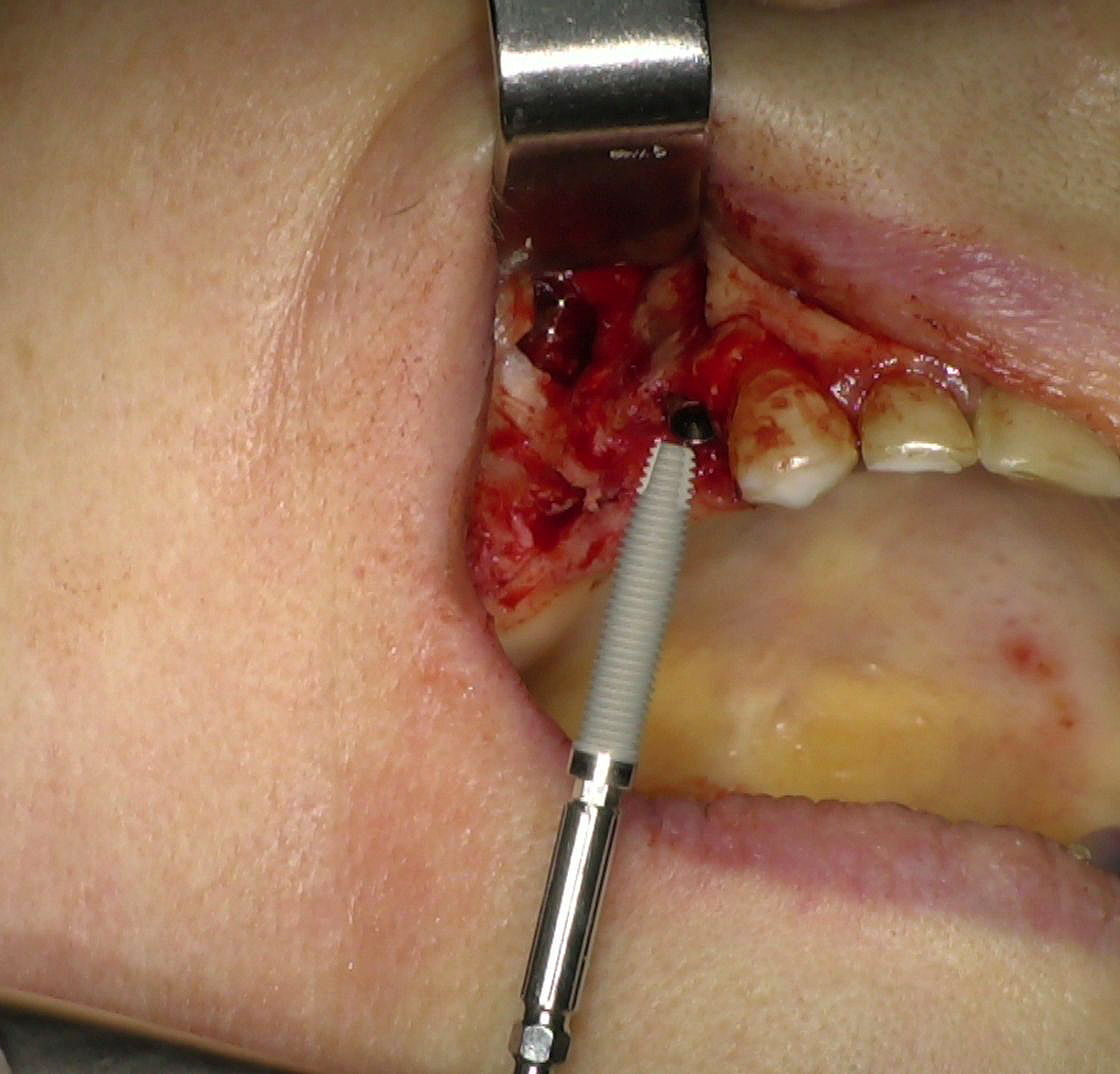 Fig. 4 - Impianti BT-Rhyno