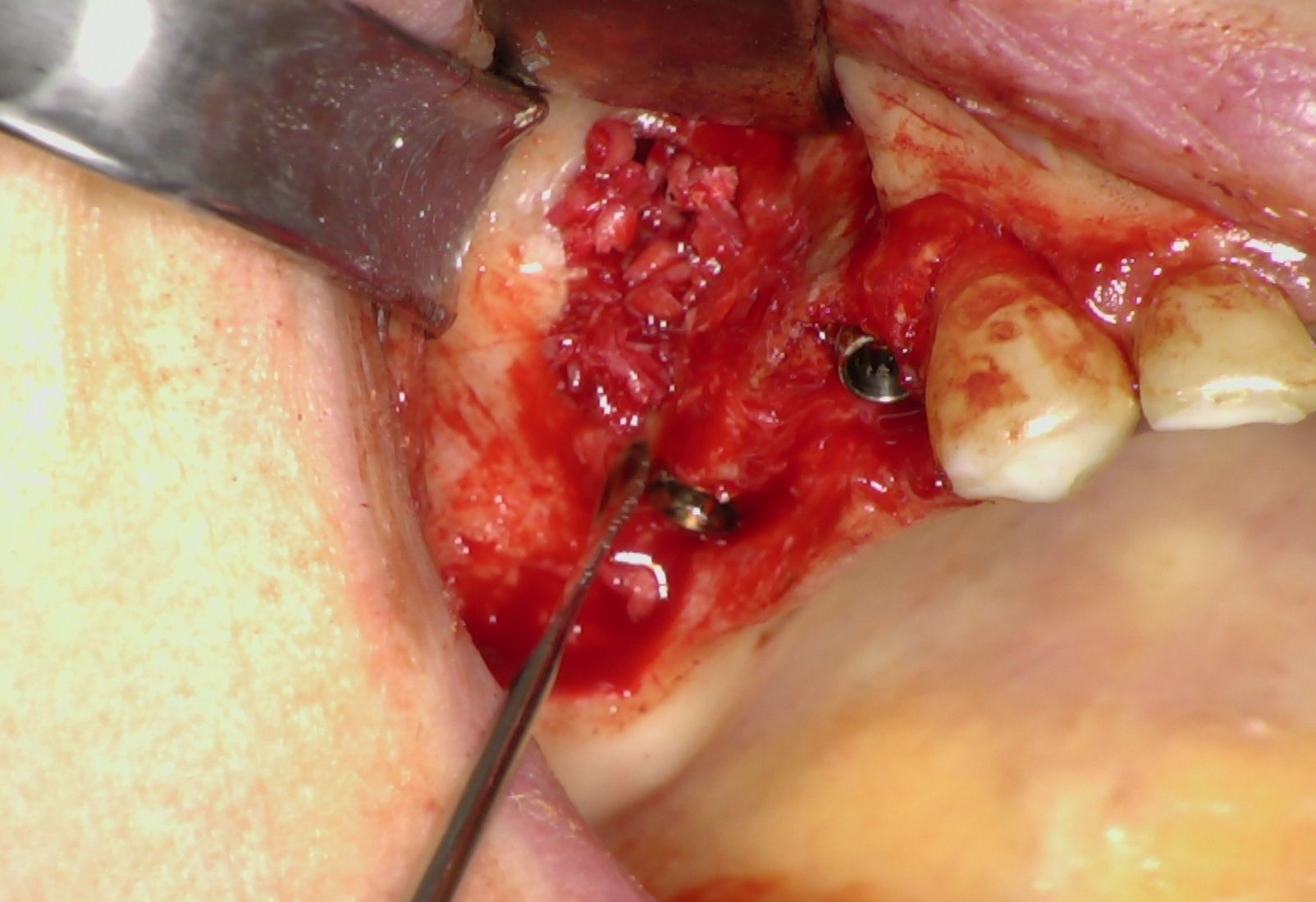 Fig. 5 - Osso autologo