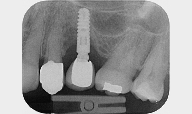 Analisi radiografica  ad un anno