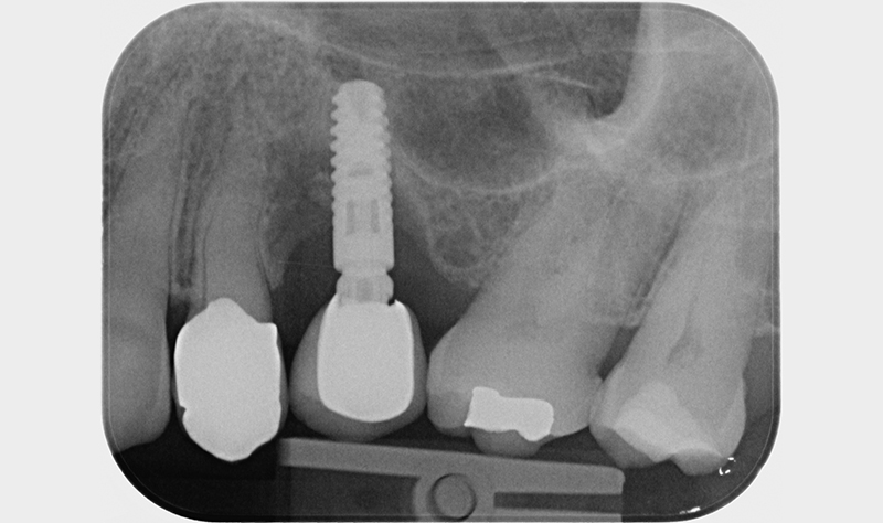 rivalutazione radiografica dei 6 mesi