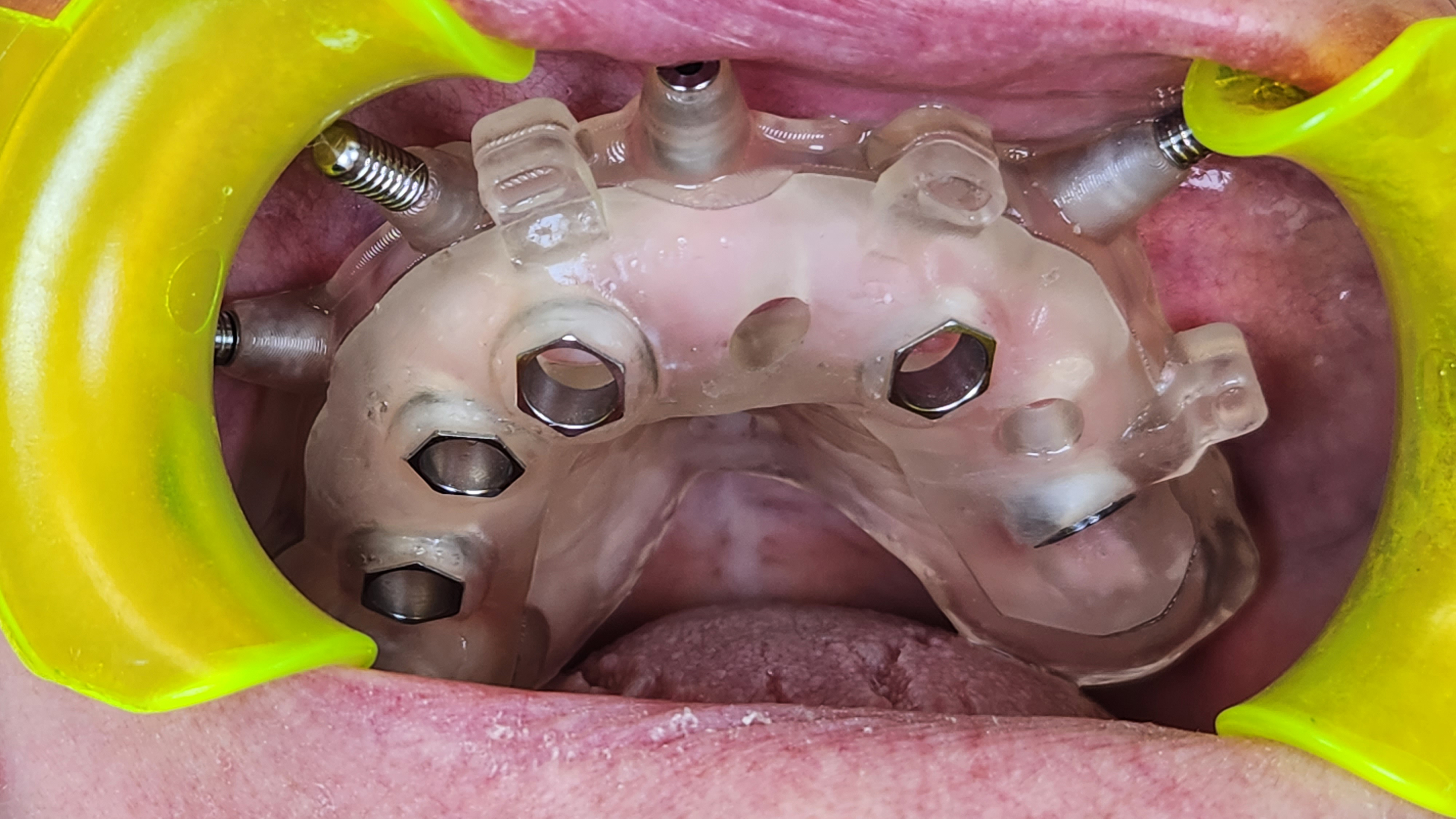 dettaglio del posizionamento della protesi all'interno della bocca