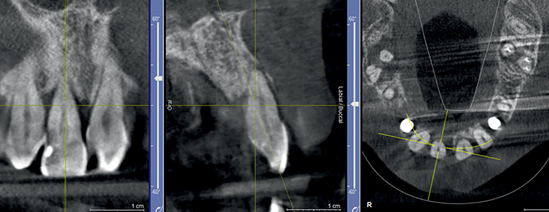 Radiografia e CBCT che mostrano difetto e perdita di struttura ossea