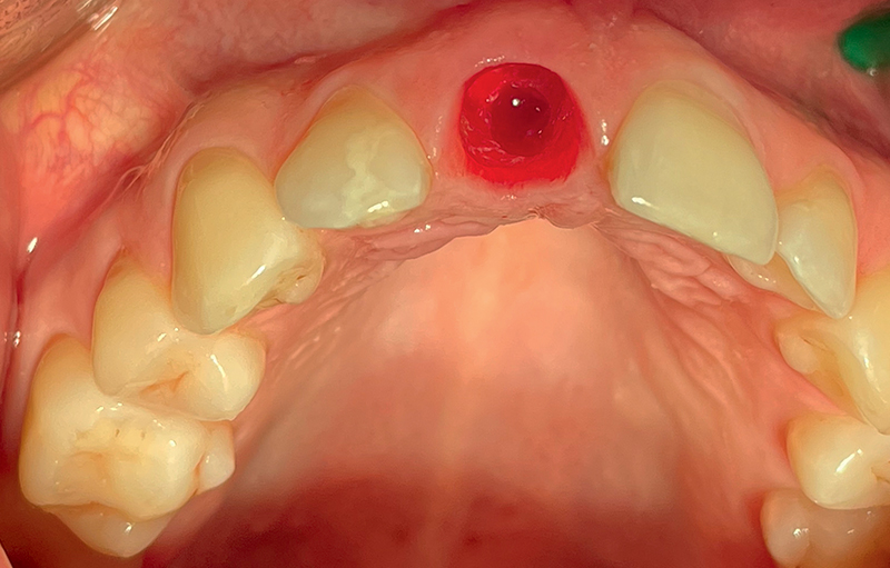 osteotomia secondo protocollo SDS