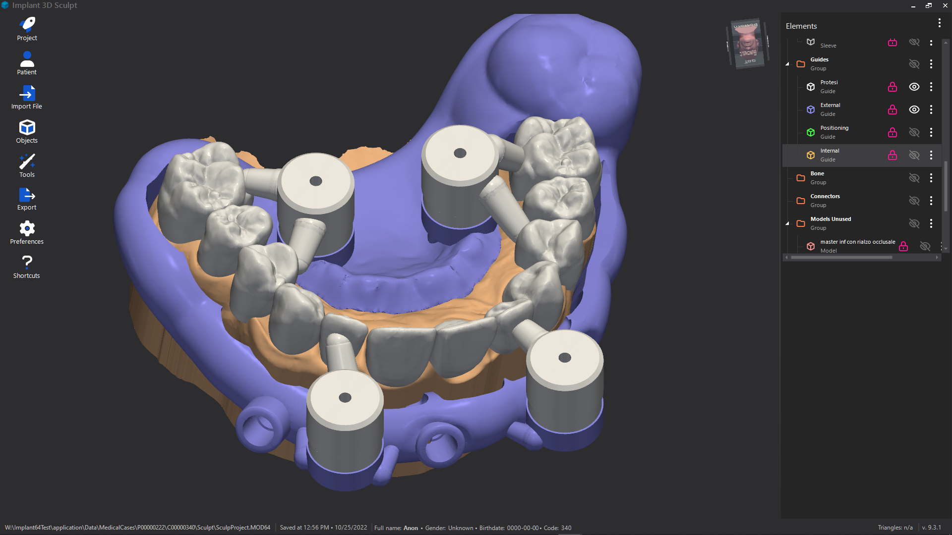 Esempio di chirurgia guidata con dima scomponibile Immagine fornita da Medialab - Implant 3D (SP)