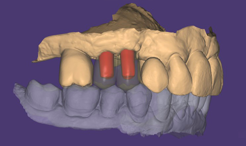 La modellazione inserita nel contesto della bocca del paziente virtuale in CAD.