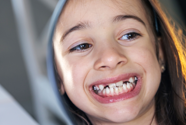 bambina mostra denti anteriori demineralizzati