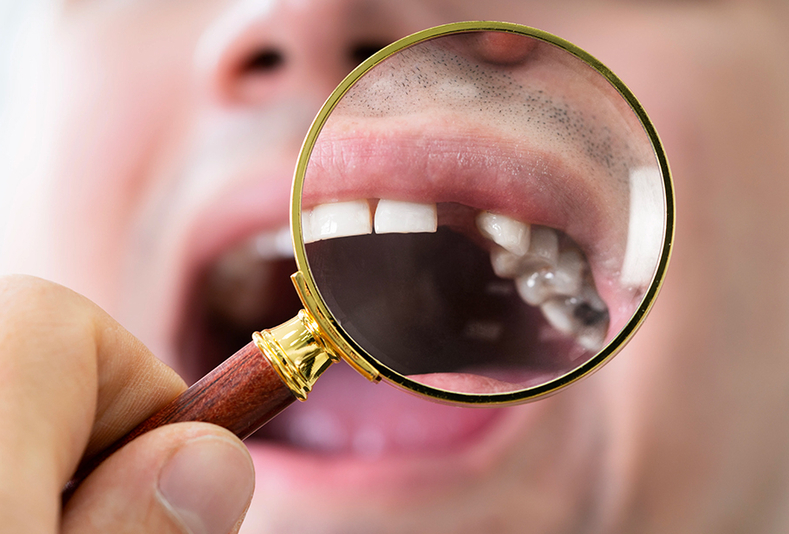 close up su bocca aperta con dente mancante