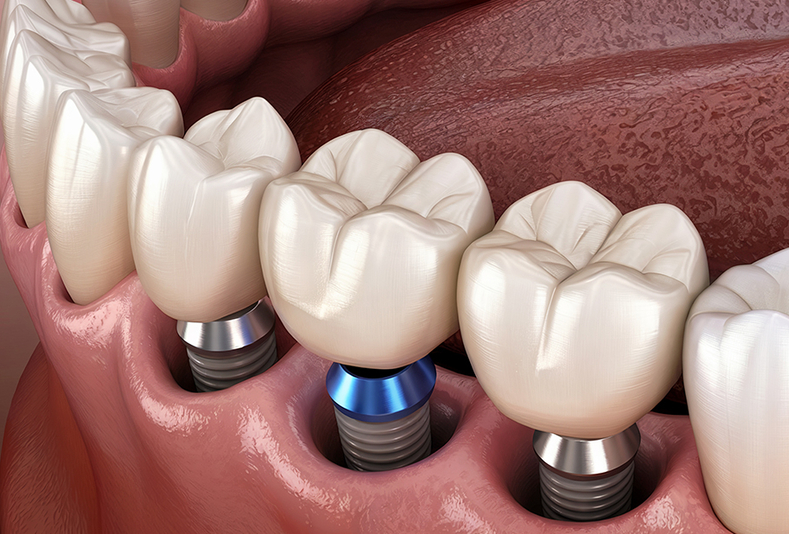 impianti dentali