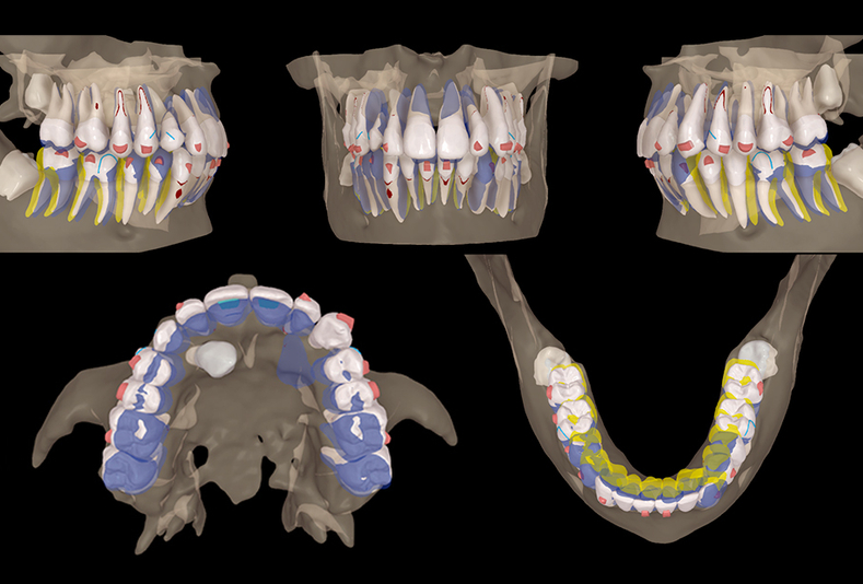 Protocollo Canine First nel recupero dei canini mascellari inclusi in S5