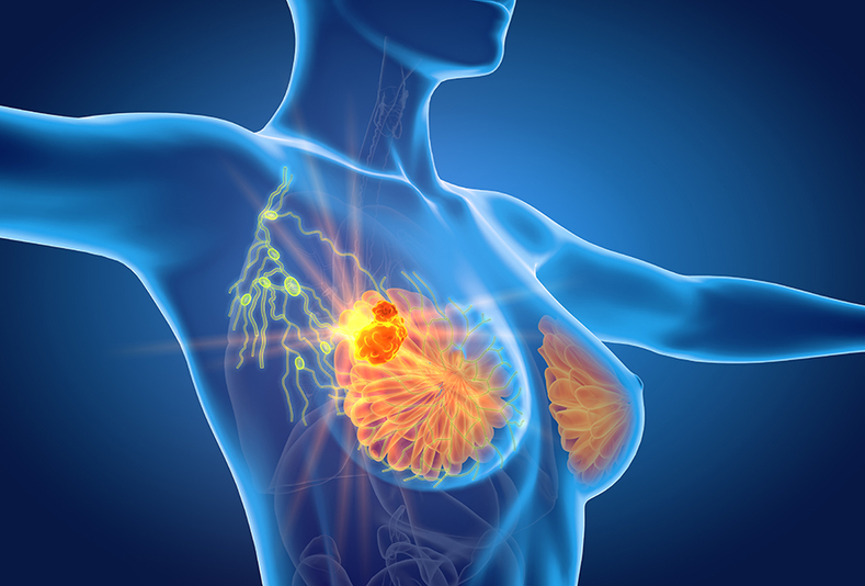 illustrazione di corpo femminile con massa nel seno