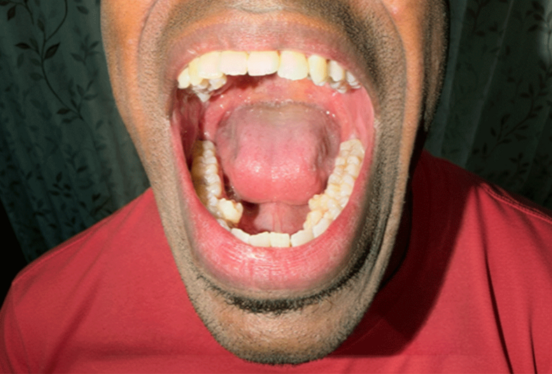 Primo piano dei denti di Prathab Muniandy