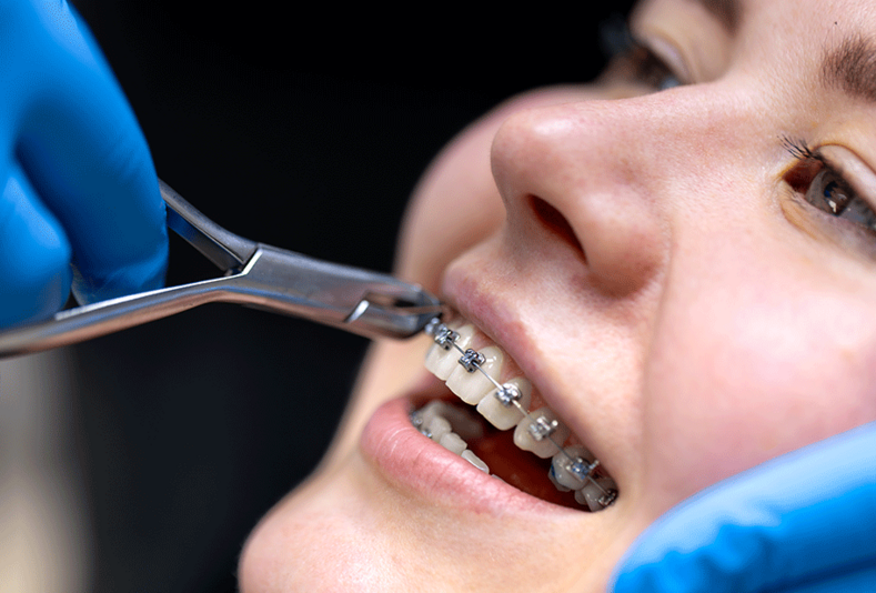 Primo piano di una ragazza dal dentista mentre le viene tolgo l'attacco ortodontico