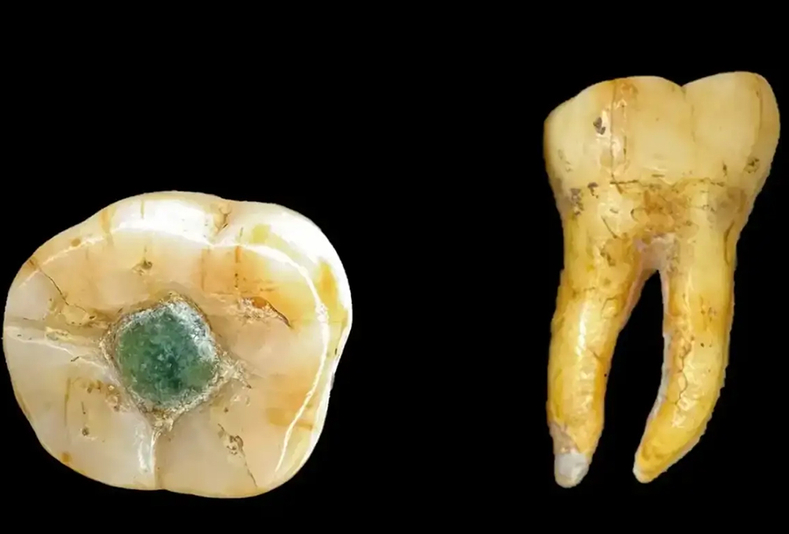 Dente con otturazione in giadeite