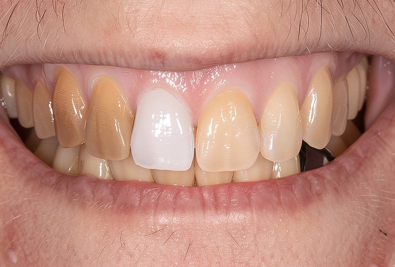 alterazione del colore dei denti