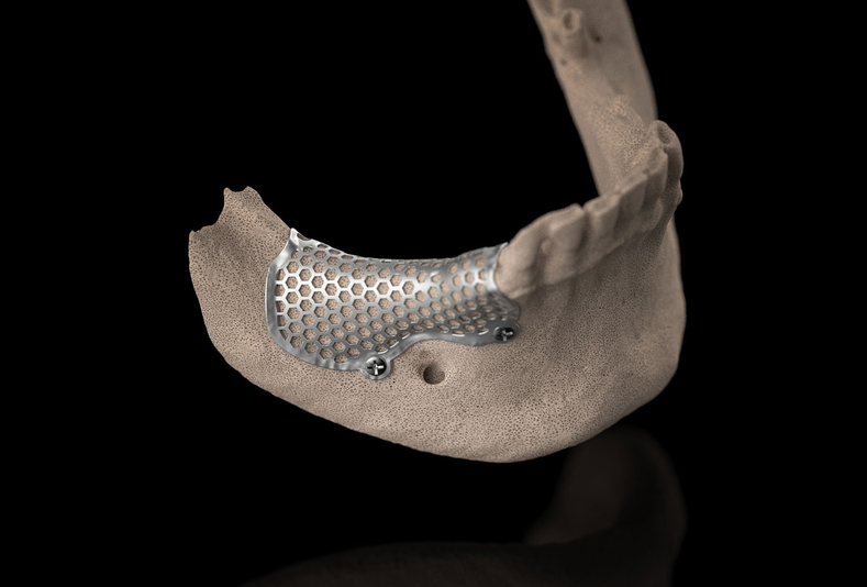3D-Mesh custom di BTK