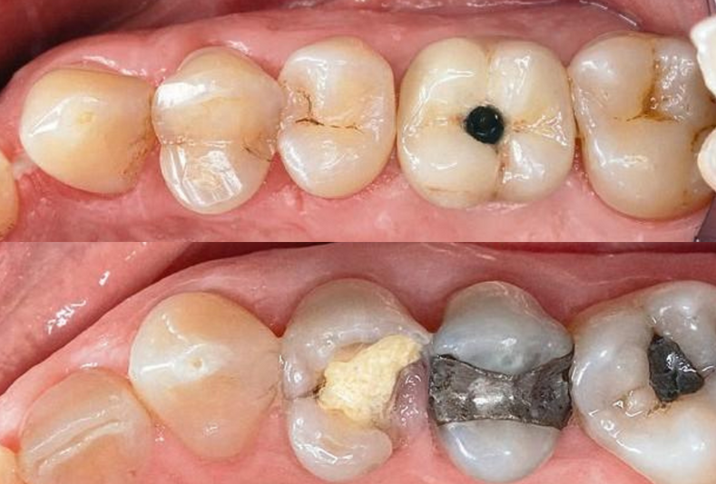 Primo piano di impianti dentali 