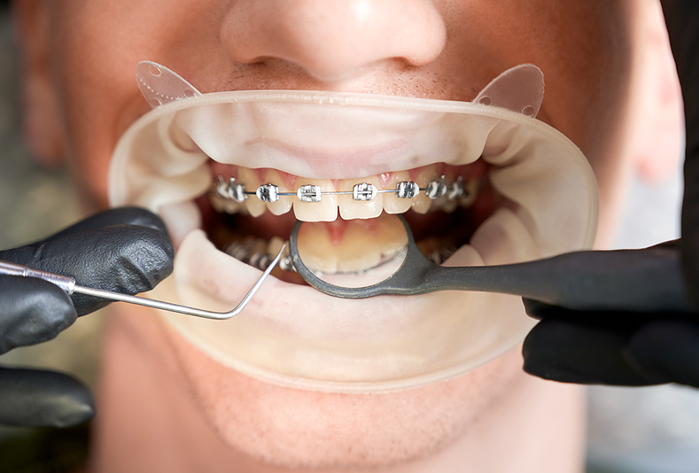 primo piano di dentatura con apparecchio fisso